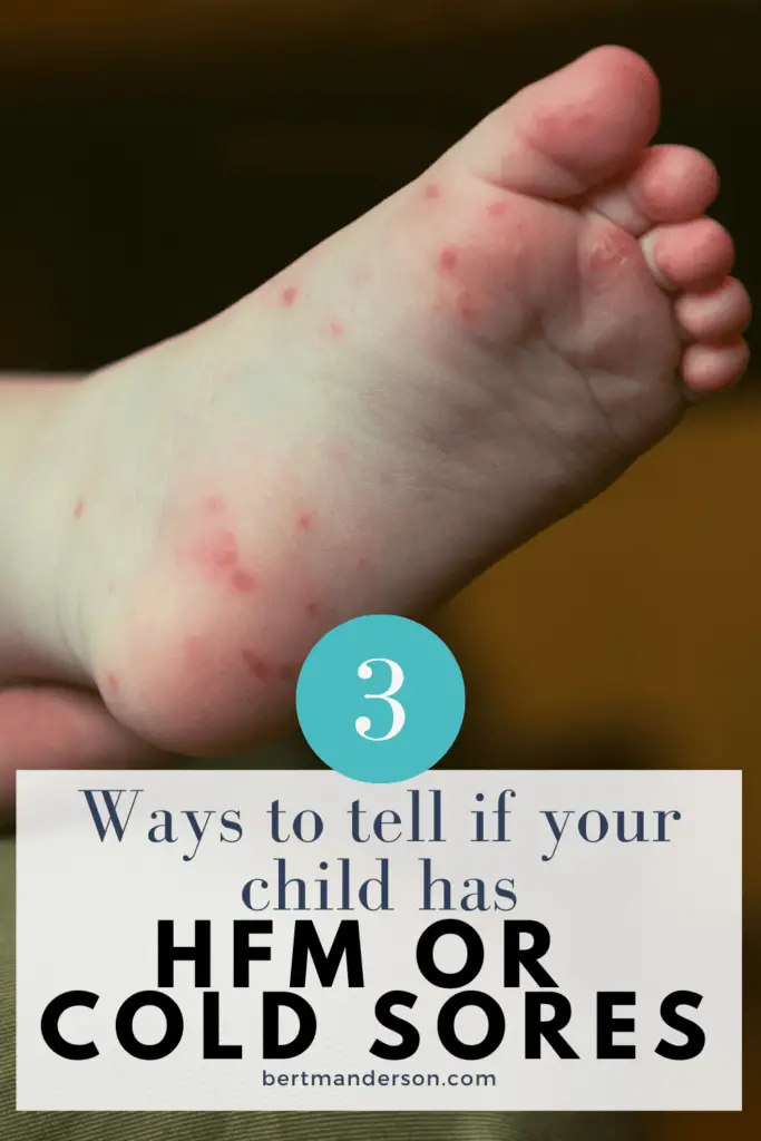 Three ways to tell if your child has hand, foot and mouth or cold sores. Baby's foot with sores on it. #handfootmouth #hfm #coldsores